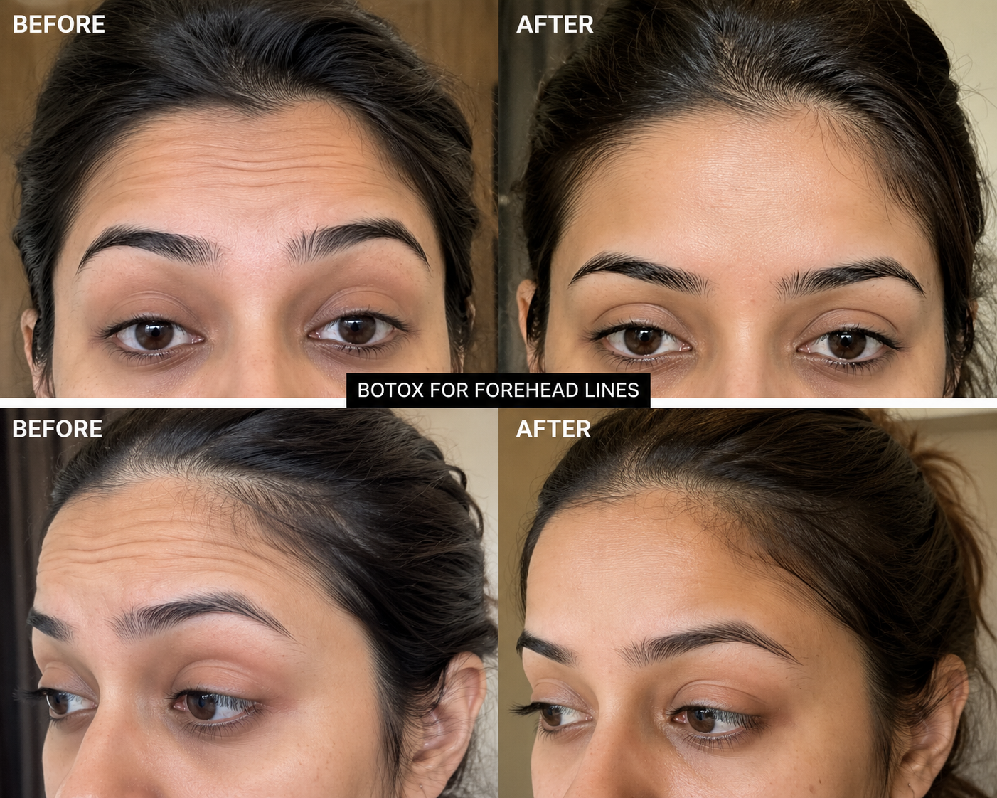 Botox · Forehead Lines